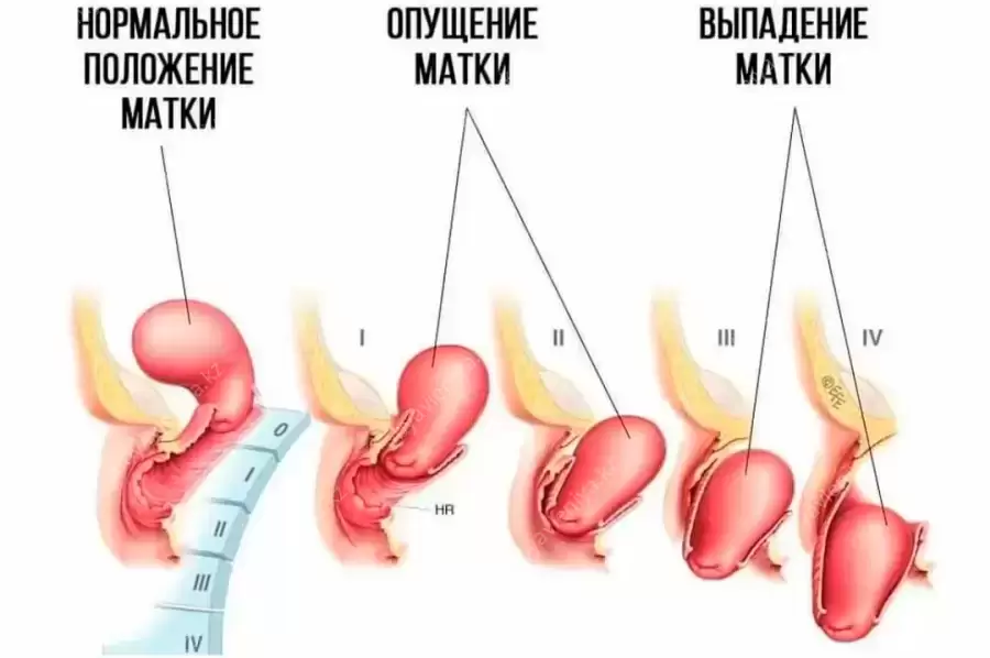 Гинекологический массаж или массаж матки