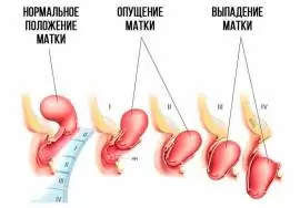 Гинекологический массаж или массаж матки 