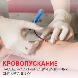 Венозное кровопускание при тяжести в ногах 